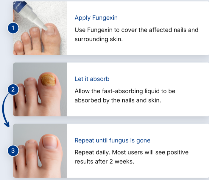 Fungexin Fungus Pen Uses