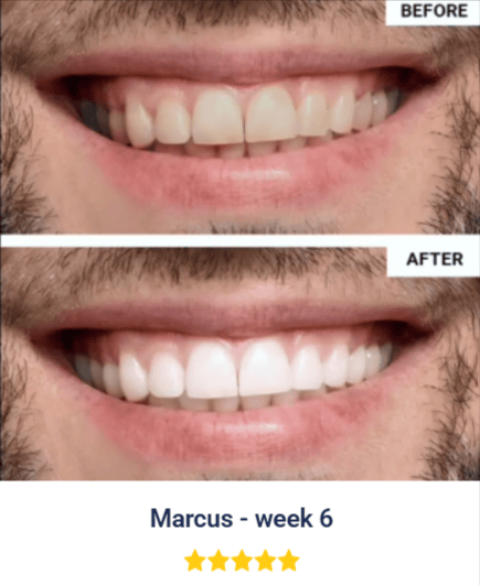 WellaWhite Teeth Whitening Kit Customer before after