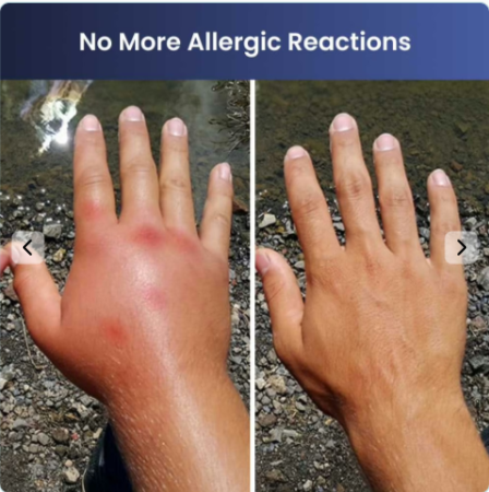 BiteRelieve-Insect-Bite-Relief Benefits