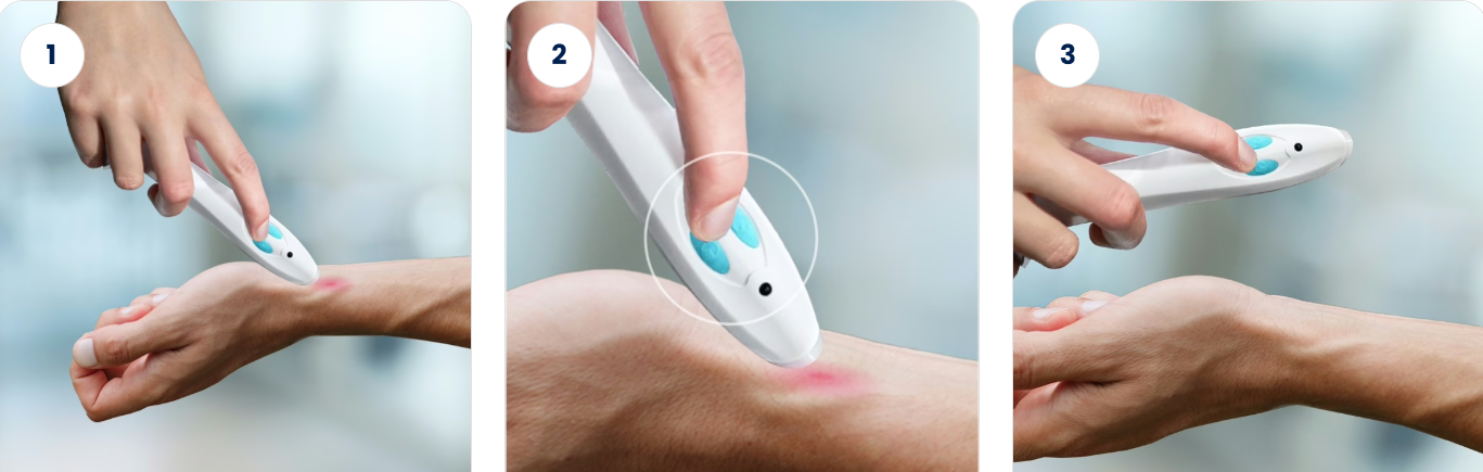 BiteRelieve Insect Bite Treatment Uses